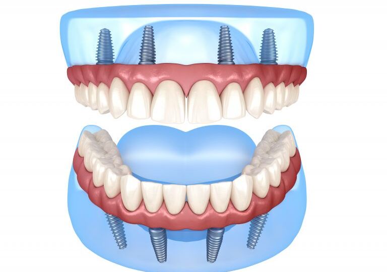 Ilustración de una dentadura con endodoncia all in four