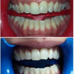 Antes y después de blanqueamiento dental