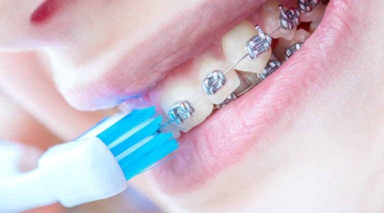 Cepillo de dientes y ortodoncia