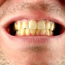 Hombre con los dientes amarillos