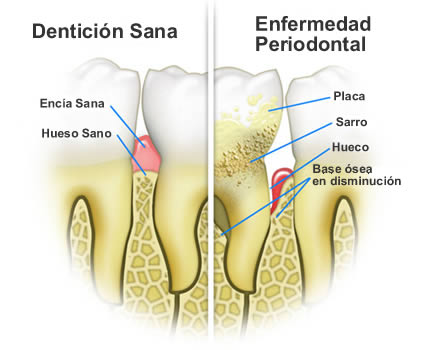 Ilustración enfermedad dental