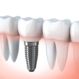 Ilustración de implante dental