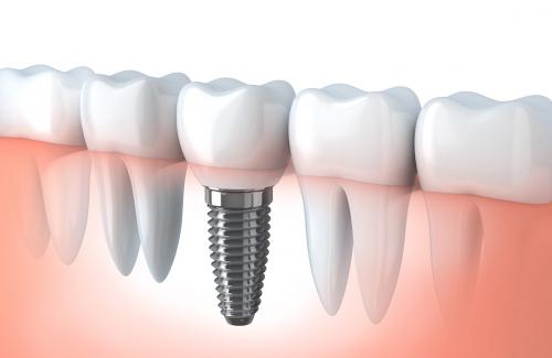 Ilustración de implante dental