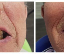 Boca antes y después de prótesis dental fija