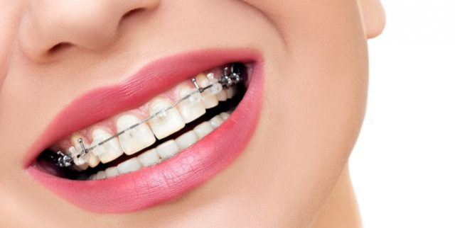 Persona con ortodoncia